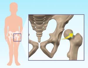 Hip Dysplasia