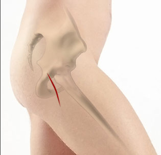 revision-knee-replacement