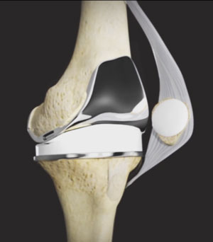 Knee Replacement Implants - OrthoInfo - AAOS